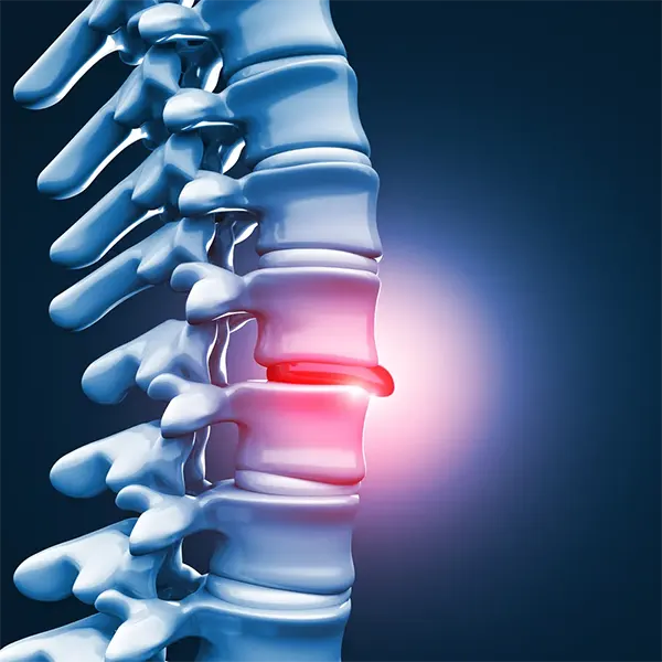 Disc Injury Treatment Near Me in Chicopee, MA. Chiropractor For Disc Injury Pain Relief.